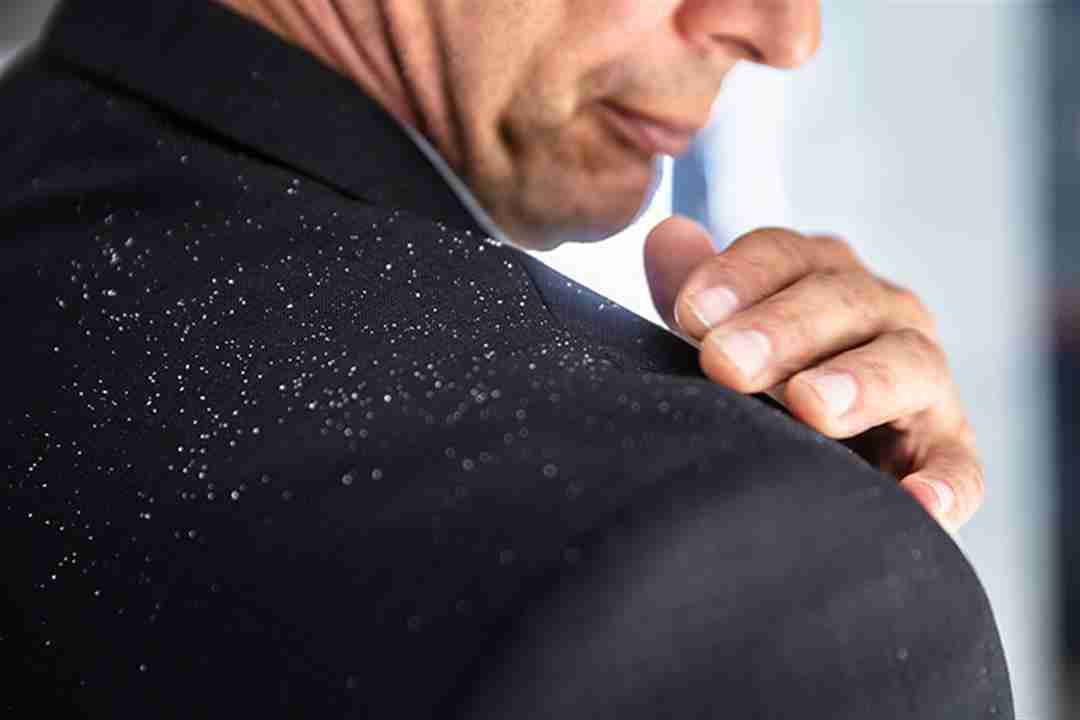 علاج قشرة الرأس في المنزل