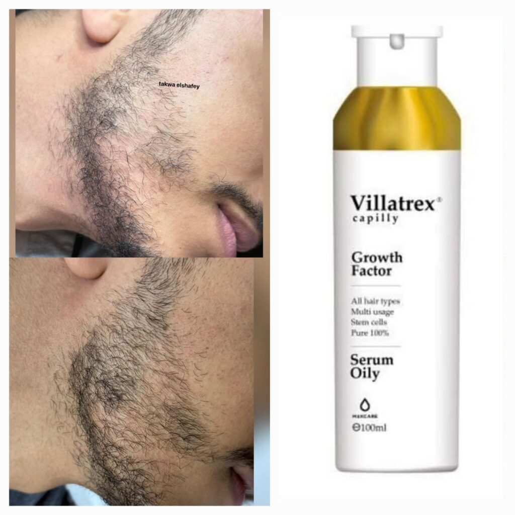 زيت سيروم علاج الصلع الوراثي والثعلبة كابيلي Villatrex 100ml — علاج الصلع الوراثي والثعلبة بعوامل النمو والخلايا الجذعية | MAXCARE